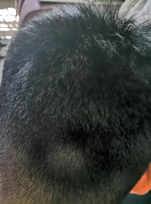 我的后脑勺后面长了一块骨头,特别硬,请问这是病吗,应该怎么治疗?谢谢