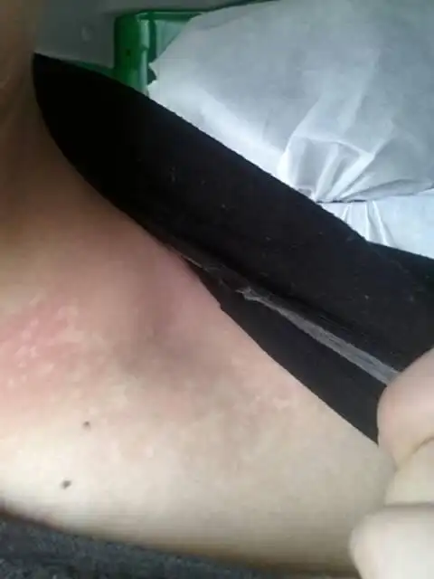 在肩膀张白色的癣,十七八岁张的,开始面积很小,最近发现扩散的很多了