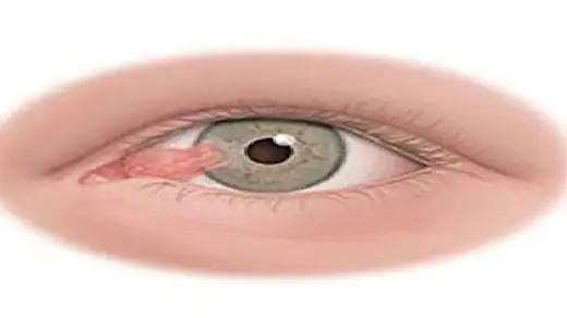 相关推荐: 眼睛里长息肉,要当心翼状胬肉! 什么是翼状胬肉?