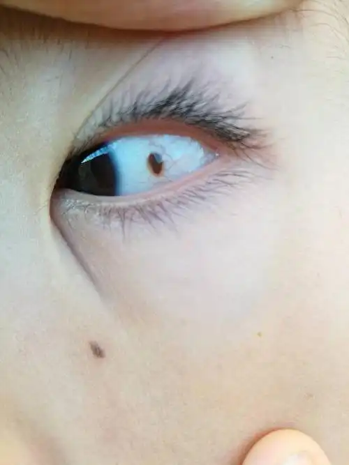 6岁的孩子白眼球上长了个黑点,是怎么回事
