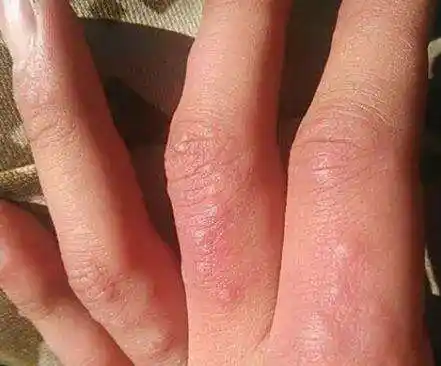 大人手长小水泡湿疹图片(夏季,手上长出小水泡,是什么原因呢?