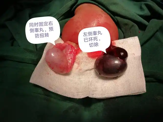 关注男孩睾丸健康_睾丸扭转_症状表现_治疗方式 - 好大夫在线