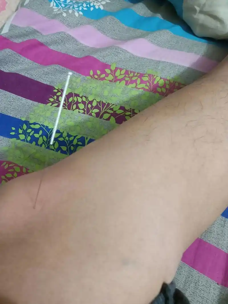 膝盖疼属于滑膜炎,就是腿部膝关节有两个窝窝! 这种疼 - 抖音