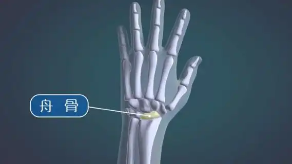 什么是腕舟骨骨折