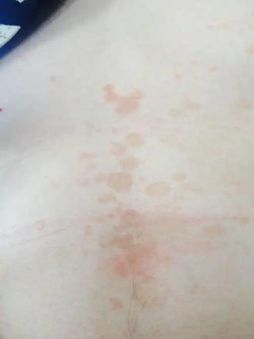 腹部有很多红斑,不痛不痒