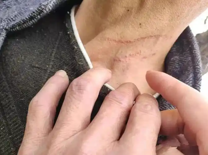 奇!勒痕引出"诈保案",只因系错安全带