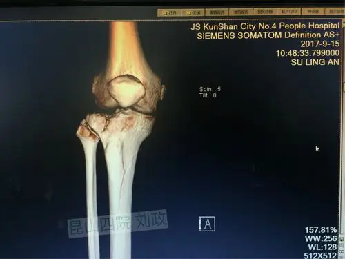 1年半前在我院手术的胫骨平台骨折,通过技术手段使患者恢复正常肢体