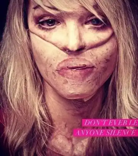 24岁遭性侵,被毁容成怪物,左眼失明,如今的她却涅盘重生,美到爆!