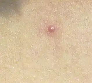 胸口长了个小红点 像红痣一样 会放射痛