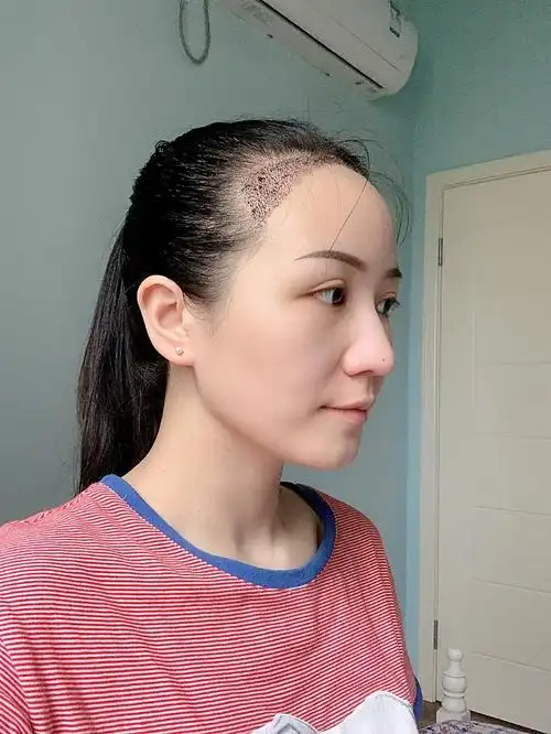 【植发第5天】还有点点轻微的肿胀,你们看我头上是不_圈子-新氧美容整