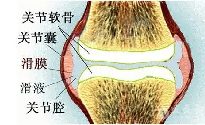 膝关节腔积液伴软骨损伤