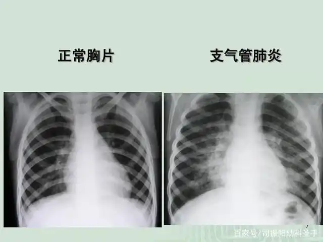 判断孩子是否为肺炎,一定要拍胸片吗?