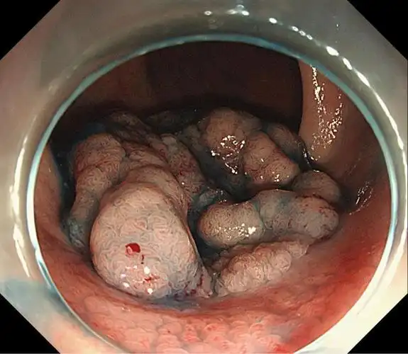 低位直肠肿瘤esd保肛成功