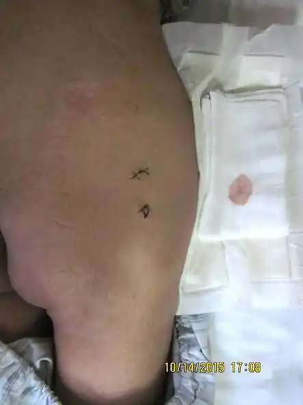 "青蛙变王子"— 微创关节镜技术治愈重症臀肌挛缩 - 好大夫在线