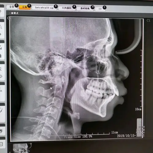 你好我这是骨性凸嘴还是齿性凸嘴以为不严重没想到凸嘴一点气质都没有