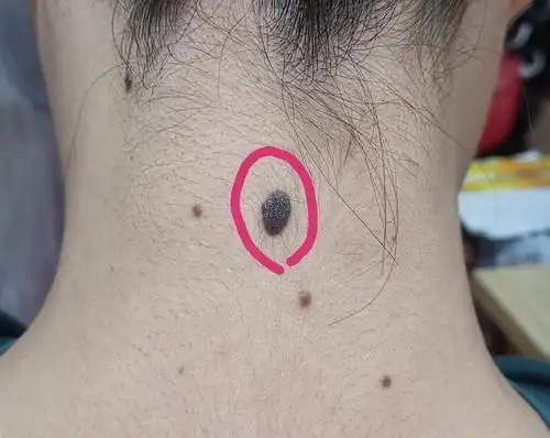 痣的边缘光滑,与周围皮肤分界清楚,而恶性黑色素瘤边缘不整齐,成锯齿