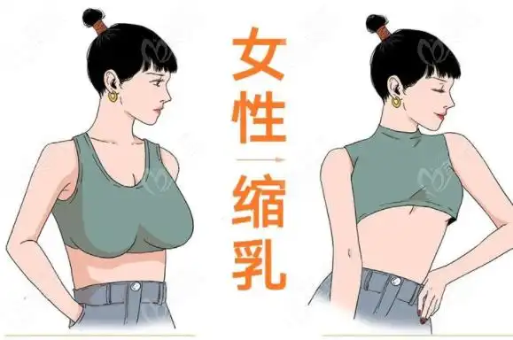 大胸可以通过手术变小吗乳房缩小这三种术式能有效改善巨乳症