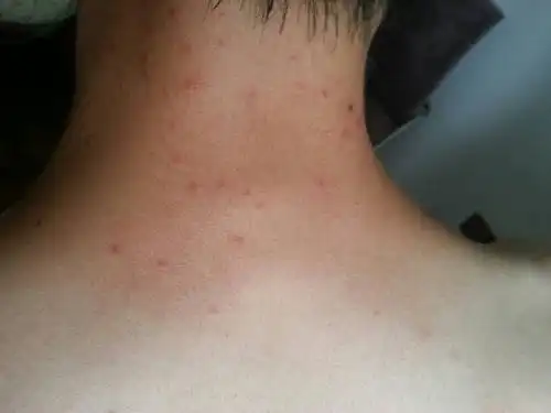 老公后面脖子突然冒出了很多红疹子,奇痒无比,不知道是什么,有可能