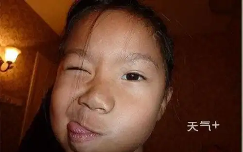 什么是中风面瘫 中风导致面瘫能治好吗