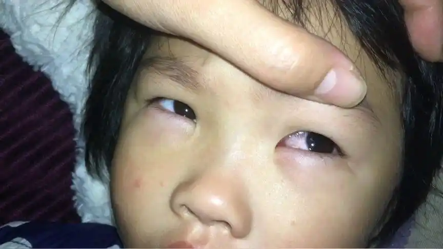 左眼睛红了
