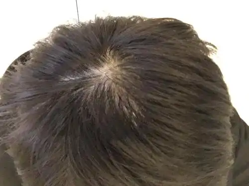 这样是脱发了么,去医院看过医生说没有明显脱发迹.