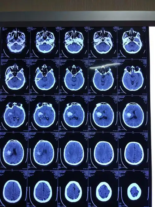 男,49岁,右侧基底节区脑出血 写美篇2018-11-06  20:00我院头ct 2018