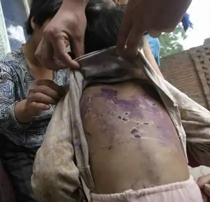 狠心婶婶虐待7岁女孩一年 女孩遍体鳞伤(组图)