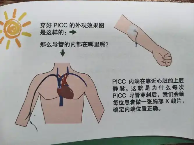 picc置管与护理