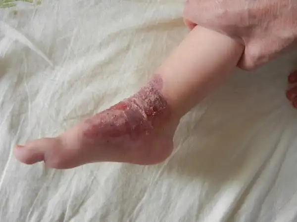 2012年李高令接治第25个烧烫伤孩子【武汉】