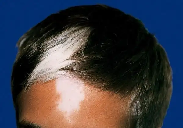 孩子出生就发现前额一小撮白头发这是白癜风吗