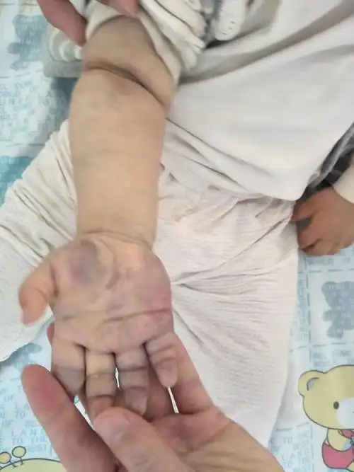 静脉畸形_海绵状血管瘤_症状表现_治疗方式 - 好大夫在线