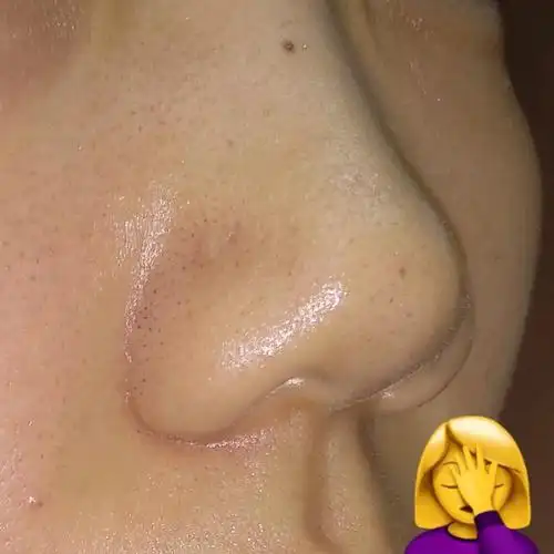 求助救救孩子吧鼻子两边的脸大片面积毛孔异常粗大鼻子长黑头0101