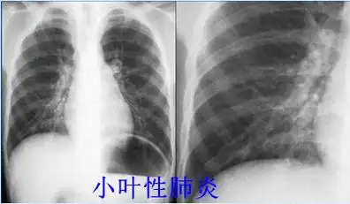 八种常见肺炎的x线诊断