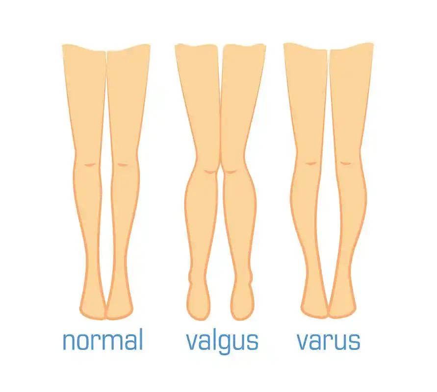 部分脂肪型的o型腿,可以通过"脂肪加减法"改善,这种方法是把大腿和