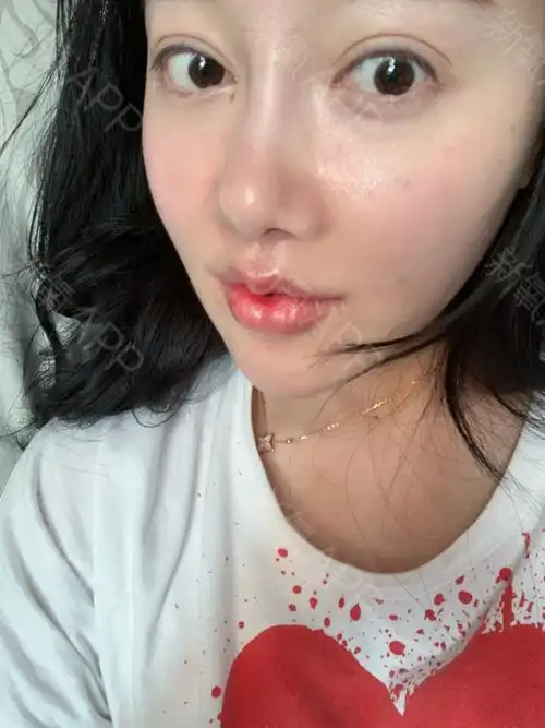 北京m唇手术好不好_效果图_珠珠啦啦m唇手术术后第45天_新氧美容整形