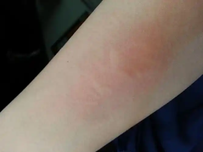 皮肤过敏?,,很痒 究竟是什么病,一捉就是一大片的了.难受c了