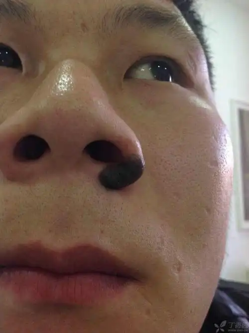 【讨论】这个鼻子的黑痣怎么处理?