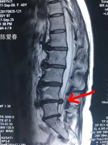 磁共振显示腰椎侧位l4/5椎间盘巨大型突出,l5/sⅠ椎间盘突出,脊髓