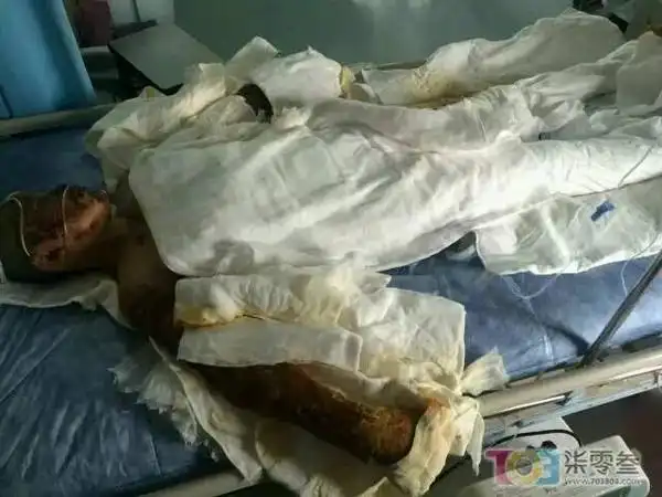 温州一美丽少女,全身58%面积的烧伤!盼援手