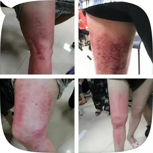 玉衡总部李氏砭法互刮分享第九次课