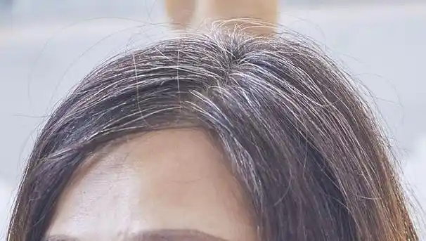 年纪轻轻就有了不少白头发,可能是什么原因?