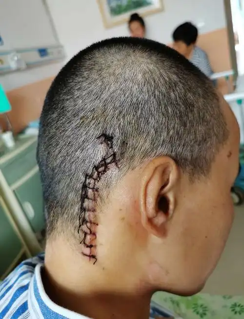 术后七天拆线,伤口愈合良好.