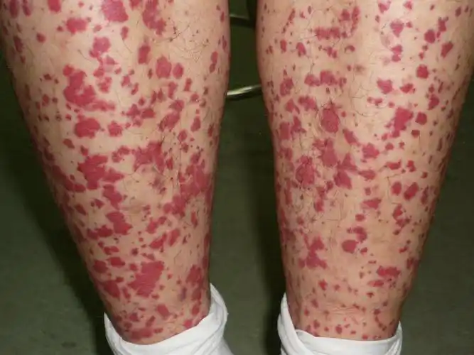 紫癜初期的图片(紫癜的早期症状及治疗方法)