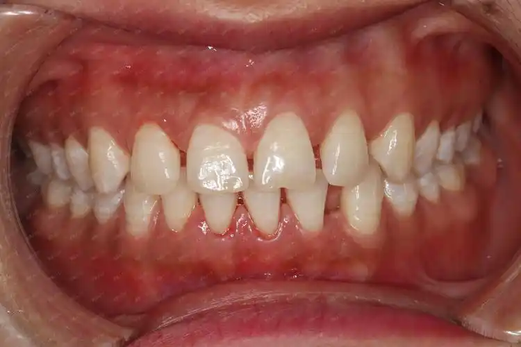 我的牙齿是属于深覆合的那种,而且牙齿非常的不整齐,_圈子-新氧美容