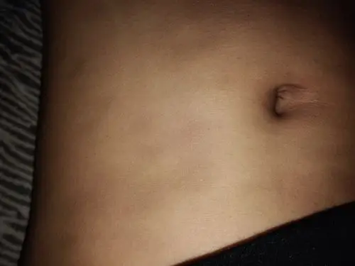 【原创】个案一篇"特发性多发性斑状色素沉着" - 皮肤及性传播疾病