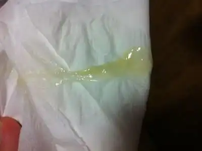 白带变黄怎么回事 怎样预防白带异常