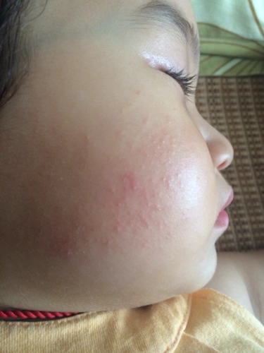 宝宝脸上粉刺一样的红点