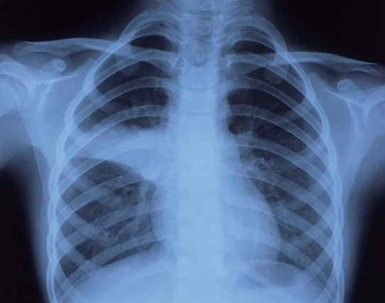 小儿肺炎 - 好大夫在线