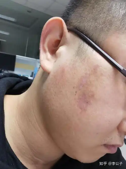 脸部果酸结痂后恢复过程