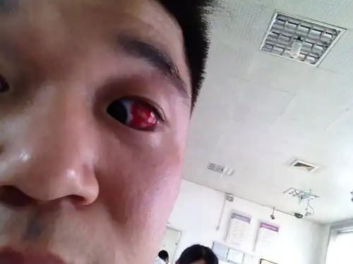 2014-06-20 高建达 医师 左眼眼球周围白色部分一半充血,很红,像是涂